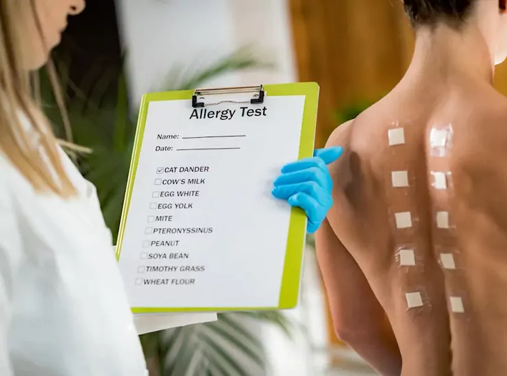 patch testing for diagnose allergy